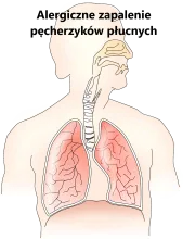 Alergiczne zapalenie pęcherzyków płucnych
