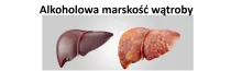 Alkoholowa marskość wątroby 