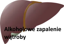 Alkoholowe zapalenie wątroby 