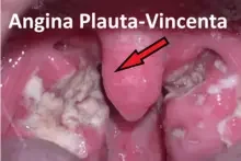 angina Plauta-Vincenta