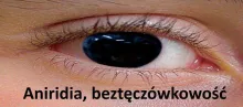 Aniridia, beztęczówkowość 