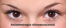 Anizometropia różnowzroczność 