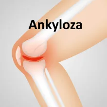 Ankyloza 