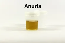 Anuria przyczyny, objawy, leczenie 