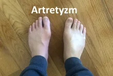 Artretyzm 