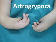 Artrogrypoza 
