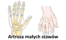 ARTROZA MAŁYCH STAWÓW RĄK I STÓP 