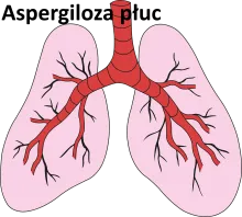 Aspergiloza płuc 