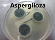 Aspergiloza 