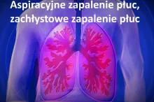 Aspiracyjne zapalenie płuc, zachłystowe zapalenie płuc 