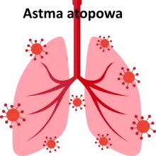 Astma atopowa, astma alergiczna, dychawica oskrzelowa alergiczna 