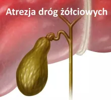 Atrezja dróg żółciowych 