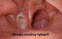 ATREZJA NOZDRZY TYLNYCH WRODZONE ZAROŚNIĘCIE NOZDRZY TYLNYCH 