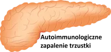 Autoimmunologiczne zapalenie trzustki 