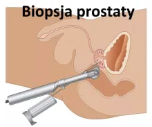 Biopsja prostaty, biopsja stercza