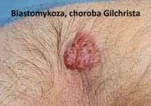 Blastomykoza, choroba Gilchrista