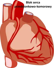 Blok serca przedsionkowo-komorowy