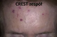 Zespół CREST 