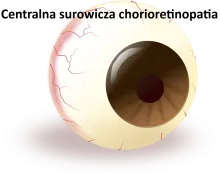 Centralna surowicza chorioretinopatia, central serous chorioretinopathy (CSCR) 
