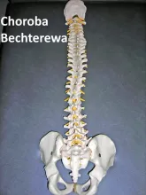 Choroba Bechterewa, zesztywniające zapalenie stawów kręgosłupa ZZSK 