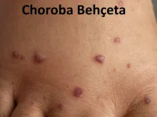 Choroba Behçeta 