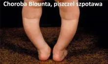 Choroba Blounta, piszczel szpotawa 