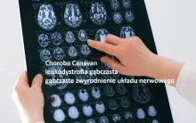 Choroba Canavan, leukodystrofia gąbczasta, gąbczaste zwyrodnienie układu nerwowego