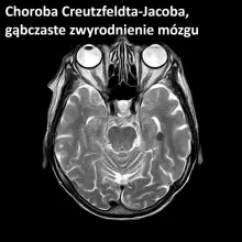 Choroba Creutzfeldta-Jacoba, gąbczaste zwyrodnienie mózgu 