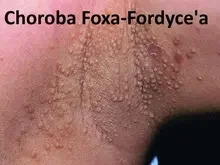 Choroba Foxa-Fordyce'a 