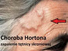 Choroba Hortona, zapalenie tętnicy skroniowej