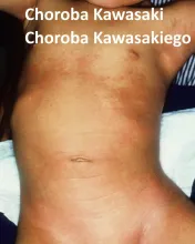 Choroba Kawasaki, choroba Kawasakiego