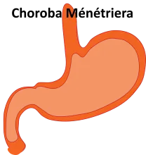 Choroba Ménétriera