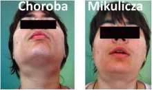 Choroba Mikulicza, choroba Mikulicza-Radeckiego 