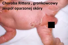 gronkowcowy zespół oparzonej skóry, Choroba Rittera 