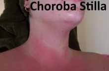 Choroba Stilla