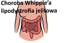 Choroba Whipple’a, lipodystrofia jelitowa 
