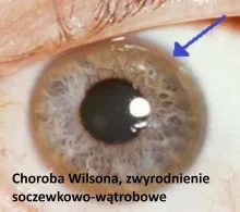 Choroba Wilsona, zwyrodnienie soczewkowo-wątrobowe 