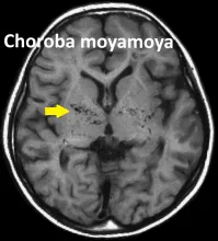 Choroba moyamoya, choroba moya moya
