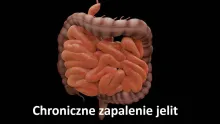 Chroniczne zapalenie jelit 