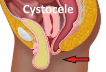 CYSTOCELE, co to, obniżenie przedniej ściany pochwy to cystocele objawy operacja zdjęcia