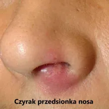 Czyrak przedsionka nosa, czyrak w nosie
