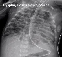 Dysplazja oskrzelowo-płucna
