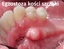 Egzostoza kości szczęki, guzek narośl jama ustna