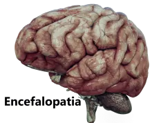 Encefalopatia 