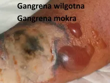 Gangrena wilgotna