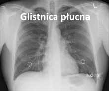 Glistnica płucna 