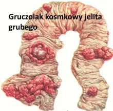 Gruczolak kosmkowy jelita grubego