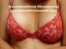 Gruczolakowłókniak fibroadenoma piersi