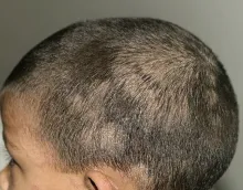 Grzybica drobnozarodnikowa u dzieci 