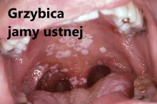 Grzybica jamy ustnej 